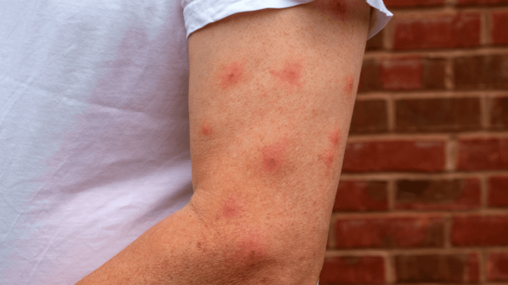 Brazo lleno de picaduras de insectos